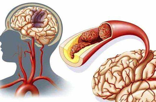 昆明南大腦科醫(yī)院 腦血管病與腦梗塞治療新技術的突破